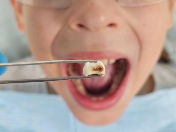 Best Emergency Dental Care for Broken or Chipped Teeth in Mountlake Terrace, WA